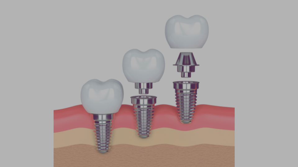 Implant-treatment