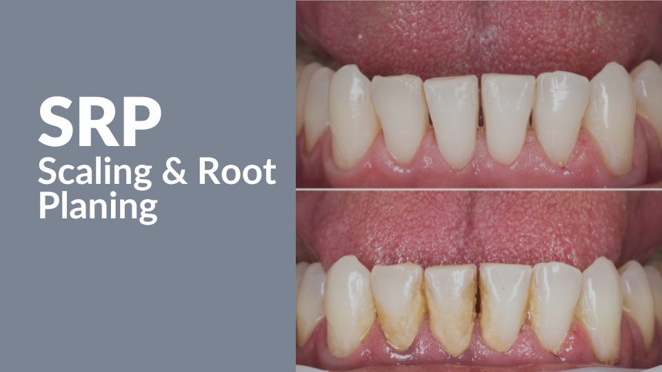 SRP Scaling and root planing dental billing course