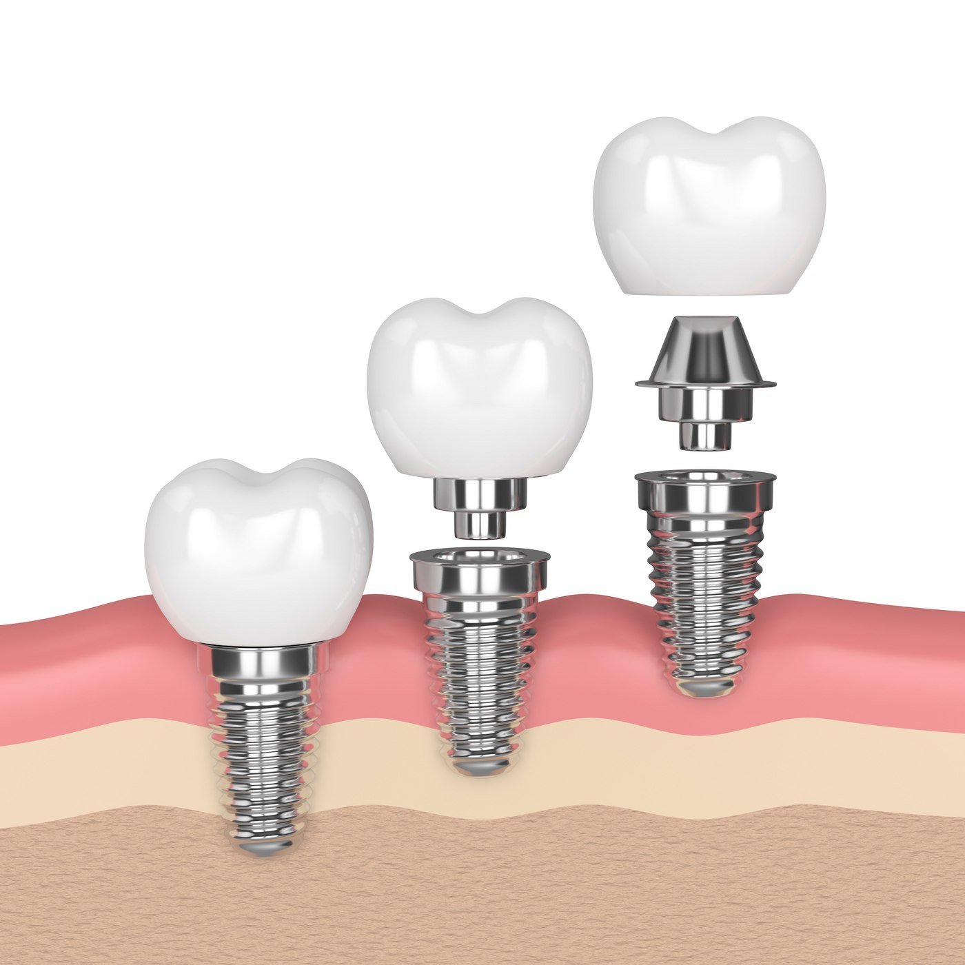 Dental Implant treatment and reimbursement from insurance